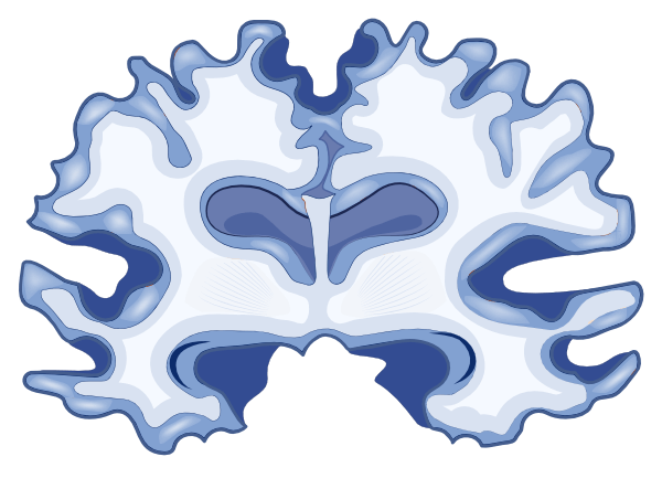 A graphic showing shrinkage in a brain with Alzheimer's